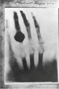 An xray of a hand with a ring on the finger.